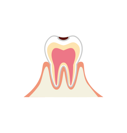 C1：エナメル質のむし歯