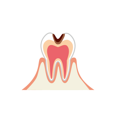 C2：象牙質に進んだむし歯
