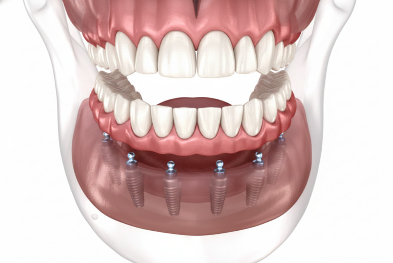 All-on-6（オールオン6）