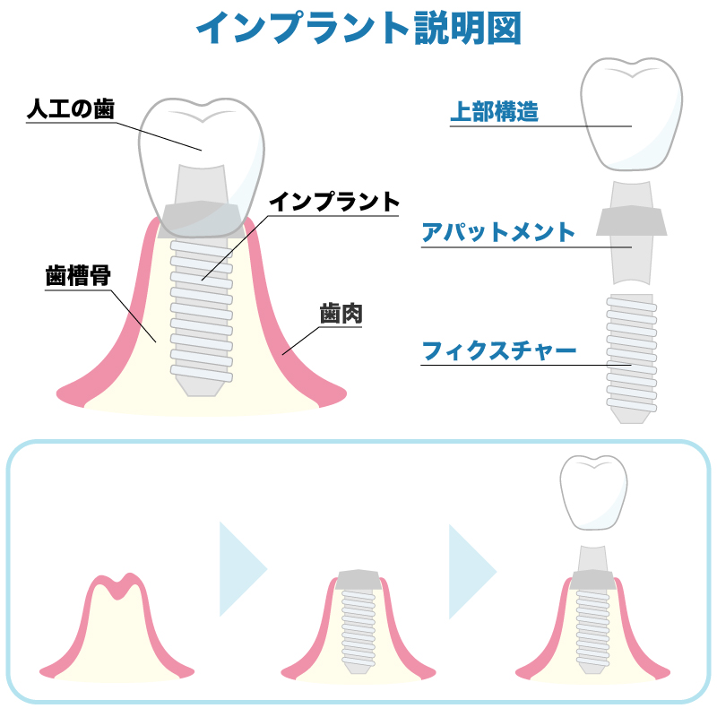 インプラント治療のイメージ