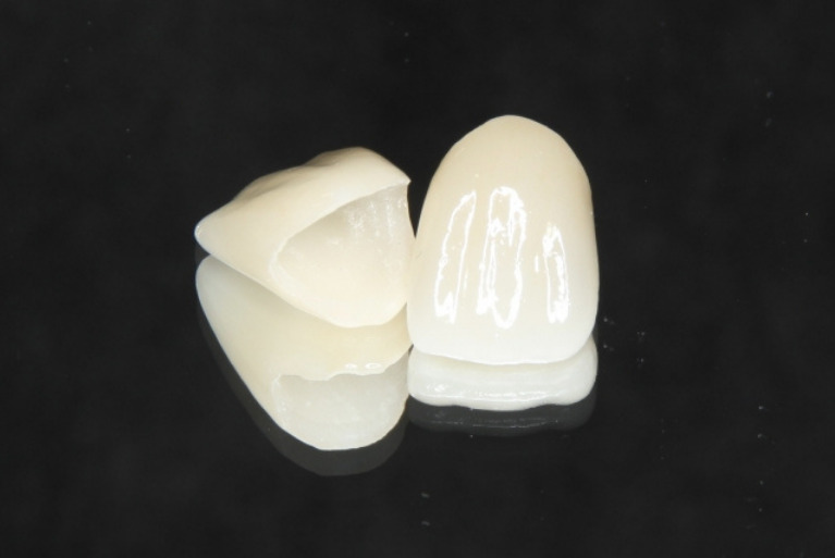 オールセラミック（e-max）