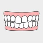 乱ぐい歯（叢生 - そうせい）