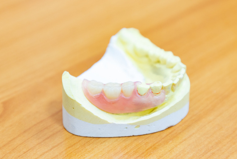 スマイルデンチャー（ノンクラスプデンチャー）