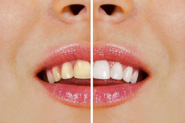 デュアルホワイトニング