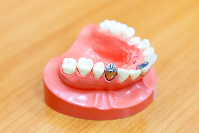 フルジルコニア