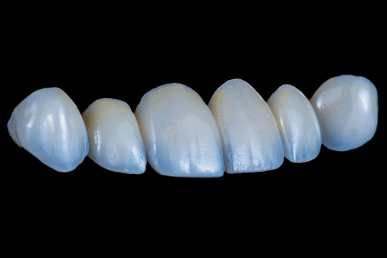 セラミック矯正