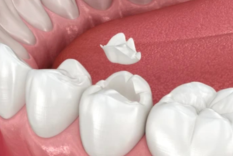 セラミック素材の推奨