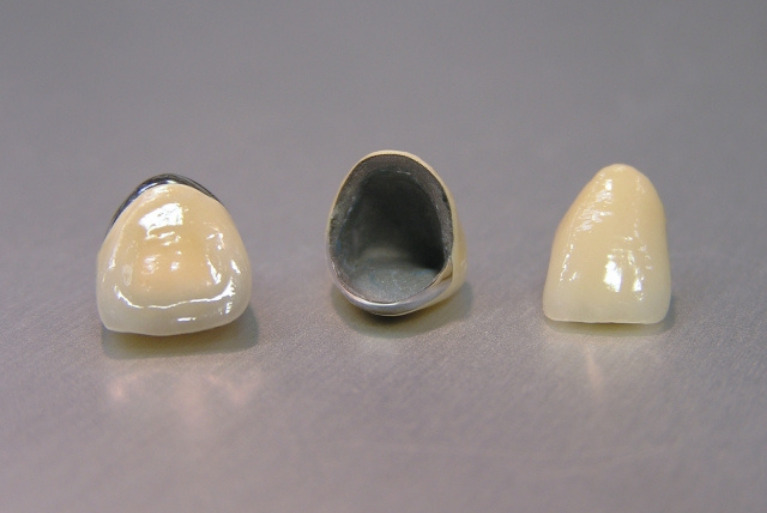 メタルボンド