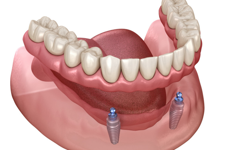 インプラントデンチャー（オーバーデンチャー）