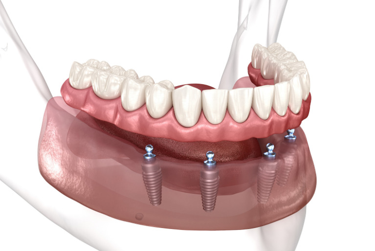 All-on-4（オールオン4）