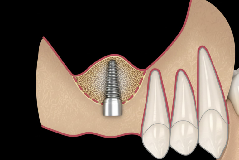 ソケットリフト法
