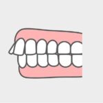 出っ歯（上顎前突 - じょうがくぜんとつ）