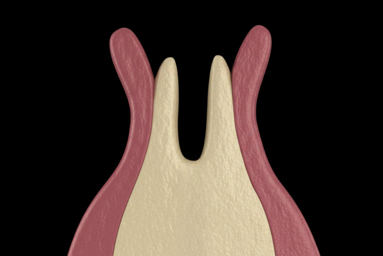 スプリット法