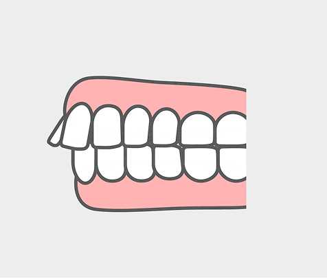 出っ歯（上顎前突）