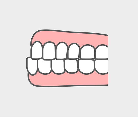 受け口（下顎前突）