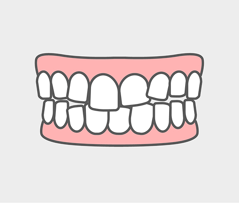 乱ぐい歯（叢生）