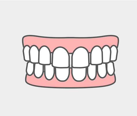 すきっ歯（空隙歯列）