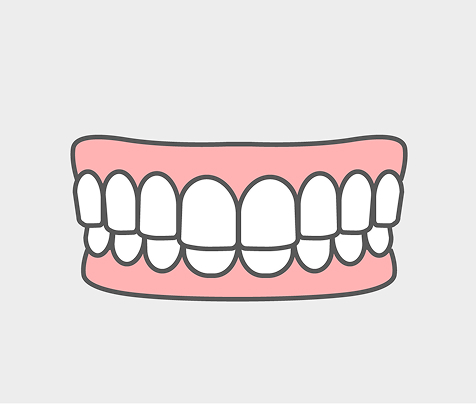 過蓋咬合（ディープバイト）