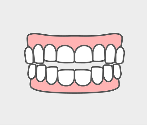 開咬（オープンバイト）